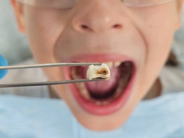 Best Emergency Dental Care for Abscessed Tooth in Franklin Grove, IL